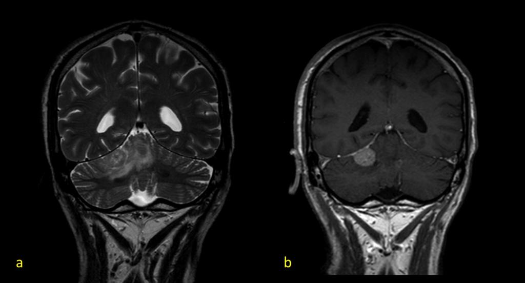 Fig. 18: Metástasis dural en el tentorio. (a) T2-TSE coronal. (b) T13D con contraste, reconstrucción coronal.