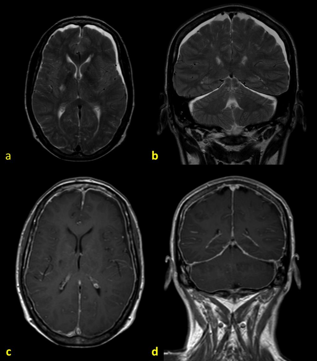 Fig. 25: Síndrome de hipotensión de LCR. (a y b) T2-TSE axial y coronal. Se visualizan colecciones subdurales en ambas convexidades cerebrales y tentorio.