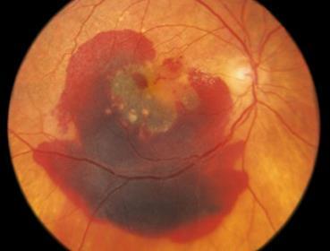 Enfermedades en la retina: Degeneración macular