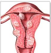 Son los tumores no cancerosos más comunes entre las mujeres en edad fértil (20% ) MIOMAS,