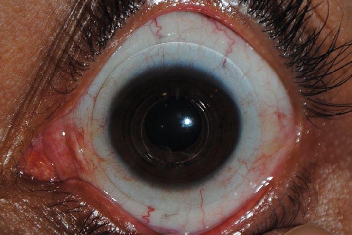 INDICACIONES DEL PACIENTE El Atlantis diseño de lente escleral está indicado para la corrección de muchas enfermedades oculares diferentes y perfiles sagitales.