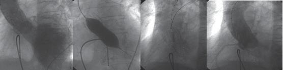 Oclusión de la arteria coronaria derecha ocurrida durante el procedimiento, y su resolución con tromboaspiración.