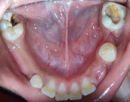 Revascularización pulpar de una primera molar permanente con ápices inmaduros llamada Pasta Hoshino. 1, pasta triple, pasta triantibiotica o Trimix.