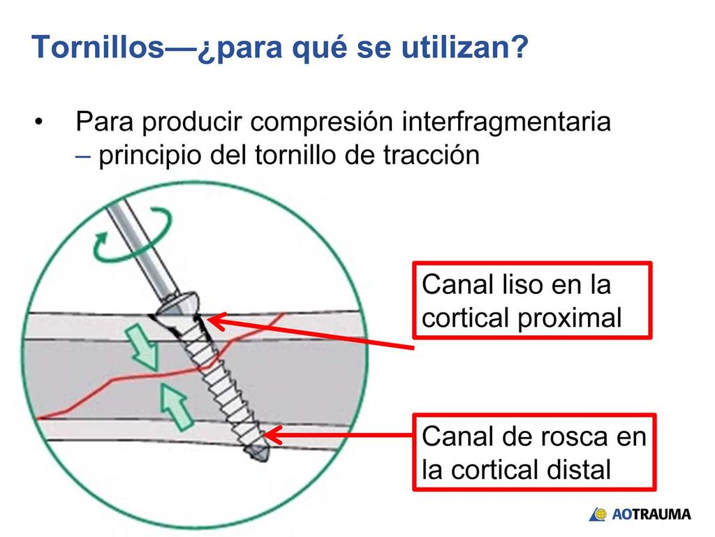 Para que un tornillo que atraviesa el plano de fractura produzca compresión interfragmentaria, la rosca debe agarrar solo en la