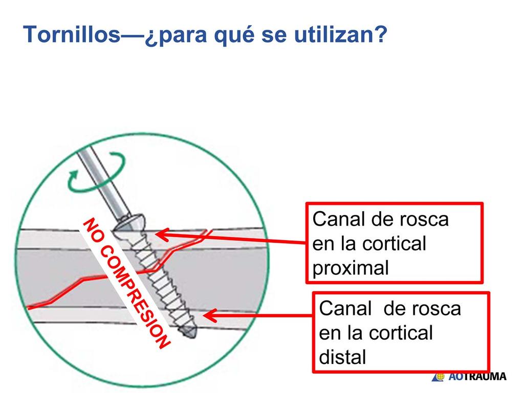 Si el tornillo que cruza el panó de fractura se agarra por igual en ambas corticales, no puede producir compresión interfragmentaria.