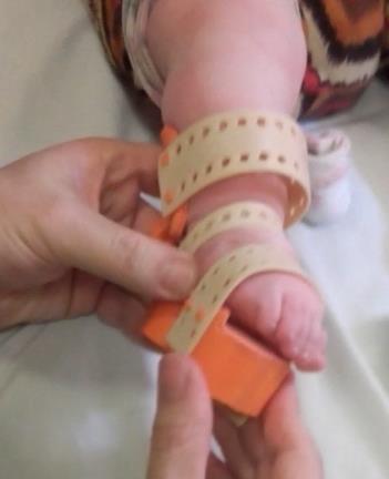 Maniobras de corrección utilizando la órtesis para pie bot, en un paciente de cinco meses de edad. Se observa el movimiento de supinación-pronación (azul).