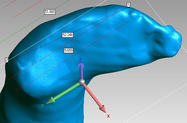 Órtesis impresa en 3D para el tratamiento de Pie