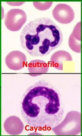 VALORES NORMALES En Adulto FLR FLA (5000-9000/mm3) Neutrófilos en cayado (NC) 0 1 % 0 90/mm 3 Neutrófilos segmentados (NS) 55 65 % 2750 5850/ mm 3 Eosinófilos (Eo) 1 4 % 50