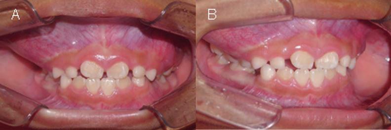 Tumor odontogénico adenomatoide. Reporte de caso Figura 2. Fotografías intraorales. A) Frontal.