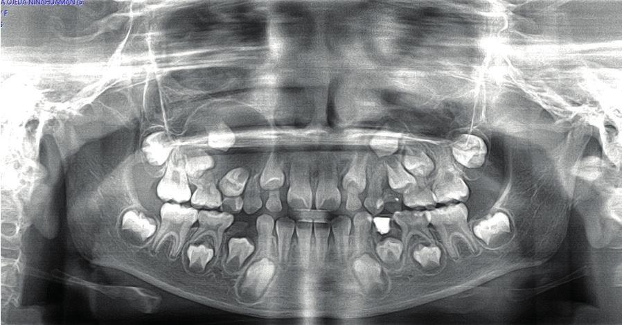 En la radiografía panorámica se observa una imagen radiolúcida localizada en el maxilar