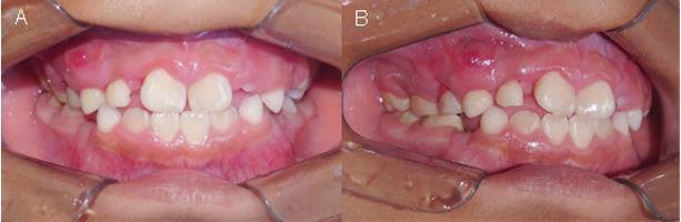 Tumor odontogénico adenomatoide. Reporte de caso Figura 8. Fotografías intraorales del control postoperatorio. A) Fotografía frontal.