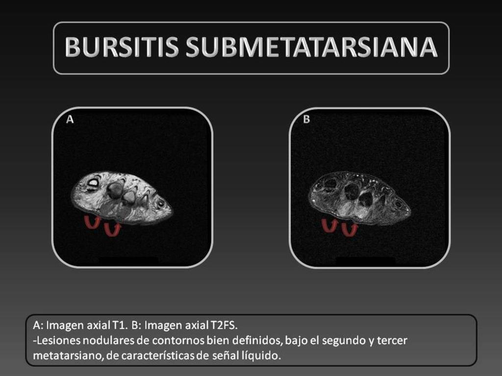 Fig. 4: Bursitis
