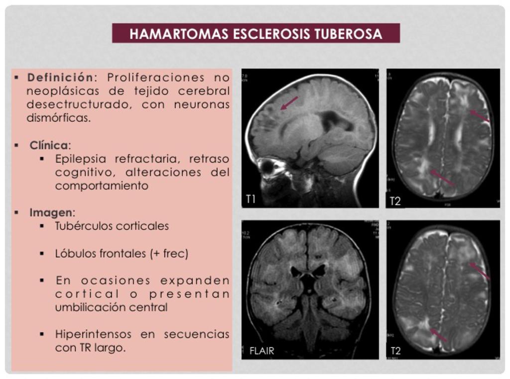 Fig. 6: Hamartomas esclerosis tuberosa Hospital