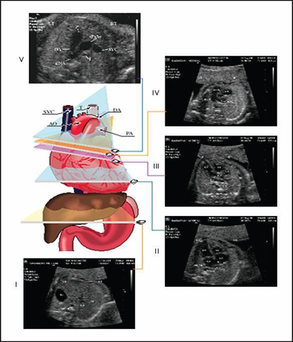 Ecocardiografía Recomendaciones de la Sociedad Internacional de Ultrasonografía en Obstetricia y Ginecología (ISUOG): Observación de sitos y posición. Relación cardiotorácica: 1/3.