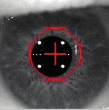 Pentacam El método de referencia para medir y analizar el segmento anterior del ojo correctamente. Es eficaz, sofisticado y es la primera opción entre muchos especialistas de todo el mundo.