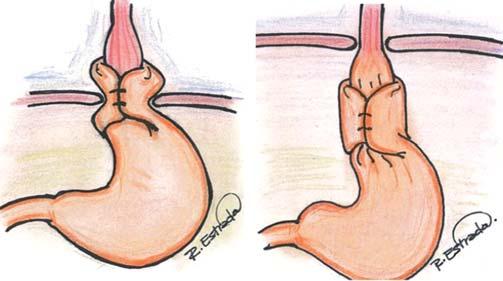 Decanini TC y cols. INTRODUCCIÓN La enfermedad por reflujo gastroesofágico (ERGE) es la patología más frecuente del esófago (75%).