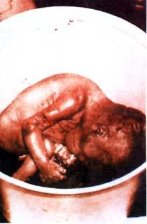 TIPO DE ABORTO INDUCIDO Aborto por Prostaglandinas 1. Esta forma más reciente de practicar el aborto, sobre todo durante la segunda parte del embarazo, 2.