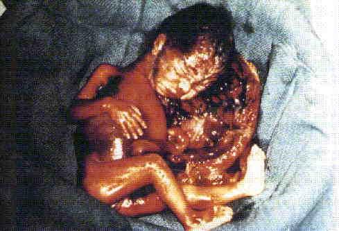 .. Aborto: El feto es