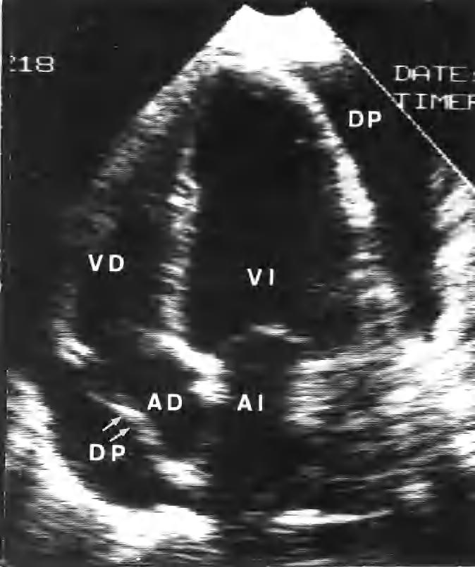 Fig. 3. Ecocardiograma 2-D de un paciente con pericarditis aguda en el que se aprecia la presencia de derrame pericárdico importante con colapso de la aurícula derecha.