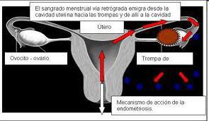 Menstruación retrograda A principios de la década de 1920 Sampson postula la teoría de la menstruación retrógrada.