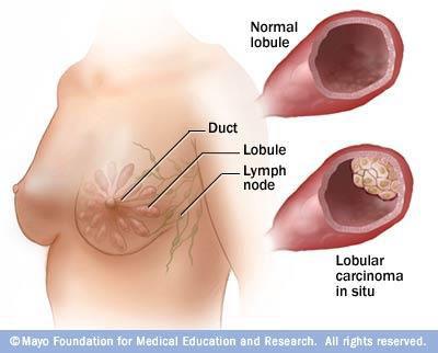 4. Carcinoma lobulillar in situ. No es una patología maligna, sino un factor de riesgo para el desarrollo de carcinoma ductal o lobulillar infiltrante. La mayoría de las mujeres son pre-menopáusicas.