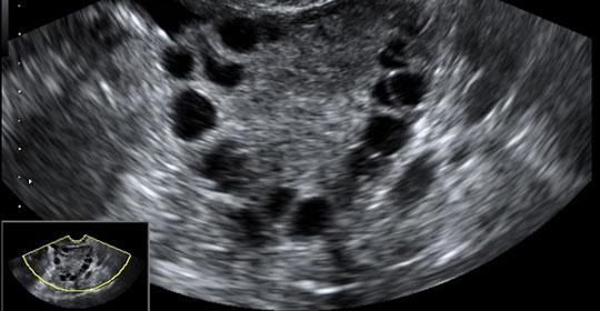 Sindrome de Ovario Poliquístico (SOP) SINTOMAS Y SIGNOS - Oligo-Amenorrea: < de 9 períodos/año, + de 35 días entre períodos, metrorragias - Exceso de hormonas