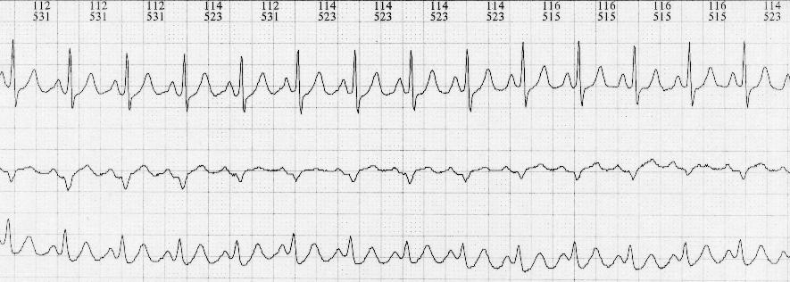 Taquicardia Sinusal por Reentrada: En el monitoreo ambulatorio se caracteriza por el