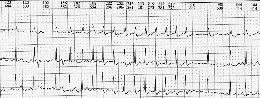 Se caracteriza por la presencia de taquicardia incesante ( mas del 50% del registro del monitoreo electrocardiográfico ambulatorio).