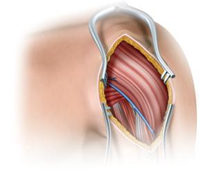 Suelte la fascia a lo largo del borde lateral del músculo coracobraquial y retírela medialmente para exponer el húmero proximal con la unión del tendón subescapular.