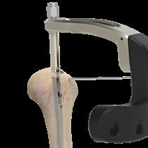 7 Colocación de los tornillos proximales Implante primero el tornillo oblicuo anterior (Figura 11) para asegurarse de que quede posterior a la ranura bicipital.