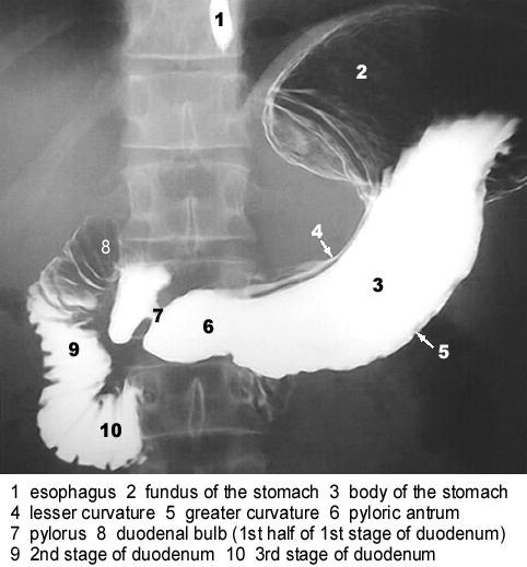Estenosis esofágica de tercio medio e inferior con dilatación superior a la estenosis Se ofrecen ahora imágenes de radiografías de tubo digestivo con