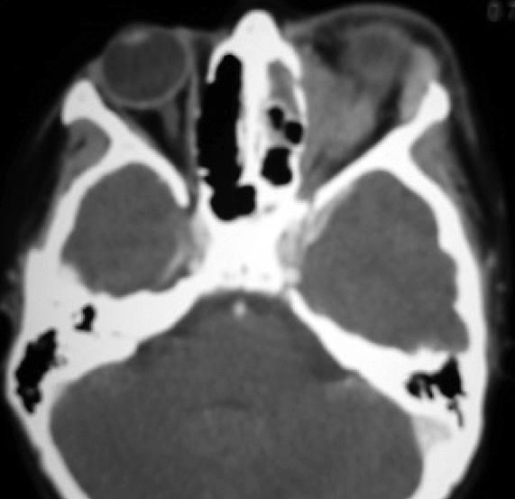 Figura 9: Rinosinusitis micótica. Tejido necrótico endonasal (en negro). Figura 7: Complicación orbitaria de rinosinusitis. TC: corte axial. Figura 10: Rinosinusitis micótica. TC corte coronal.