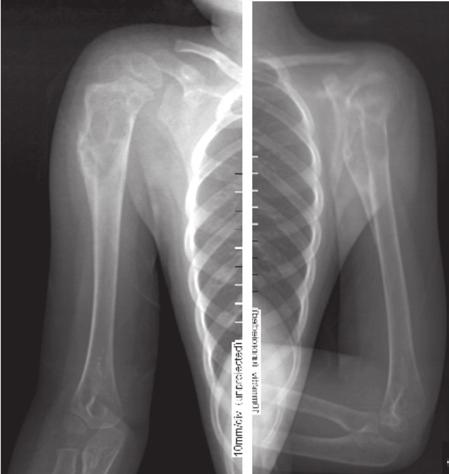 Radiografía de frente y perfil en la que se observa aspecto inicial de la lesión al momento de la primera consulta Figura 2.