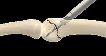 Técnica quirúrgica del sistema de tornillos para extremidades [continuación] Figura 2 3 Perforación previa y avellanado (opcional) En hueso denso, considere la posibilidad de realizar una perforación
