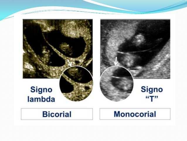 La gestación monocorial biamniotica se identifica por el signo de la T, este signo consiste en la apariencia delgada de la membrana interamniotica que sale de la placenta en