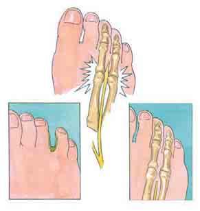 Problemas comunes de los pies Metatarsalgia