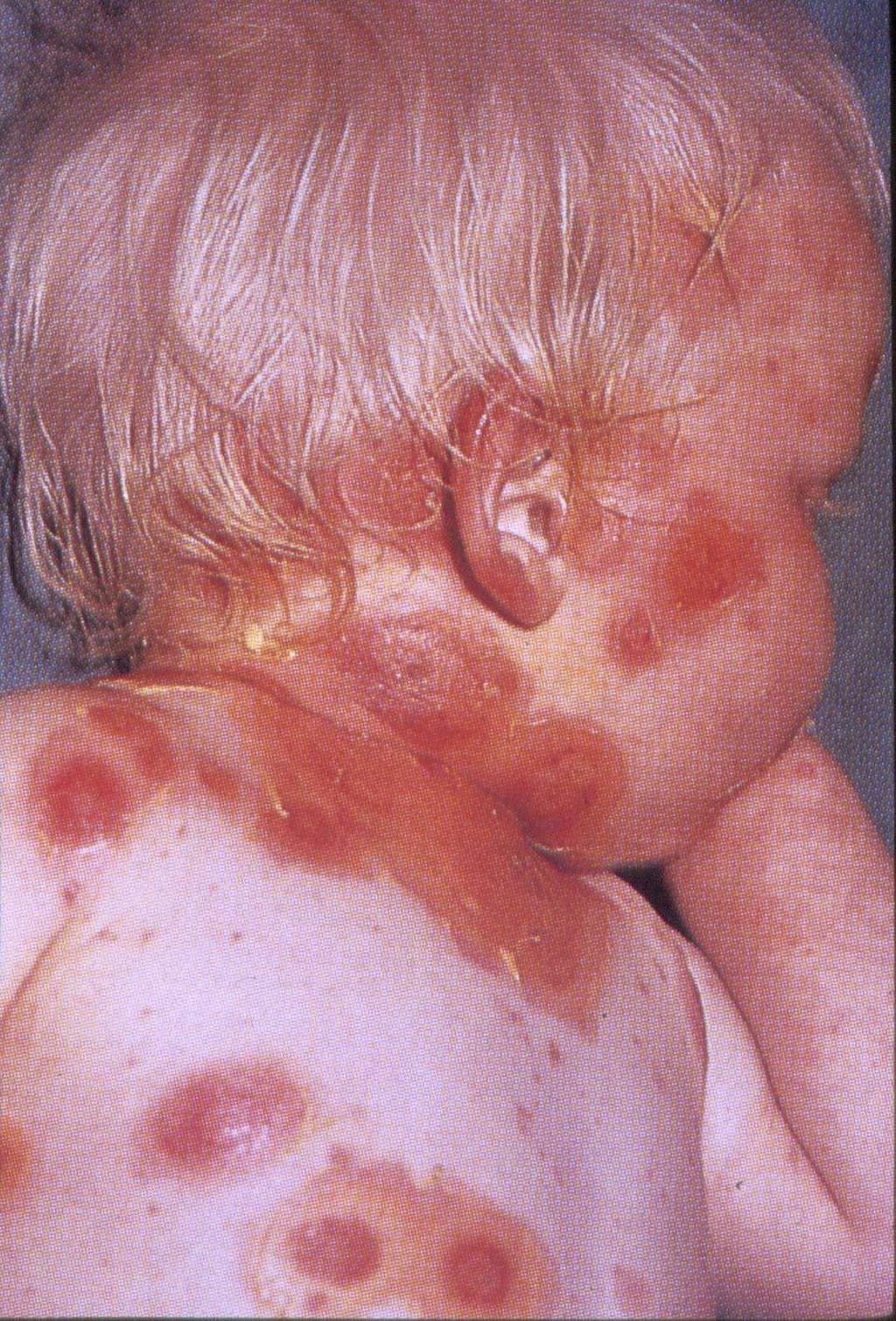Impacto de la enfermedad Varicela y herpes zoster