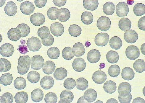 Sangre periférica. Plaquetas Son pequeñas partículas anucleadas, que intervienen en el proceso de la coagulación.