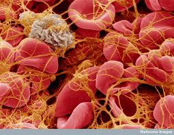 Trombocitemia Esencial No tiene síntomas Hallazgo casual en el 50% No se trata si plaquetas < de 1 millón en sangre y no hay