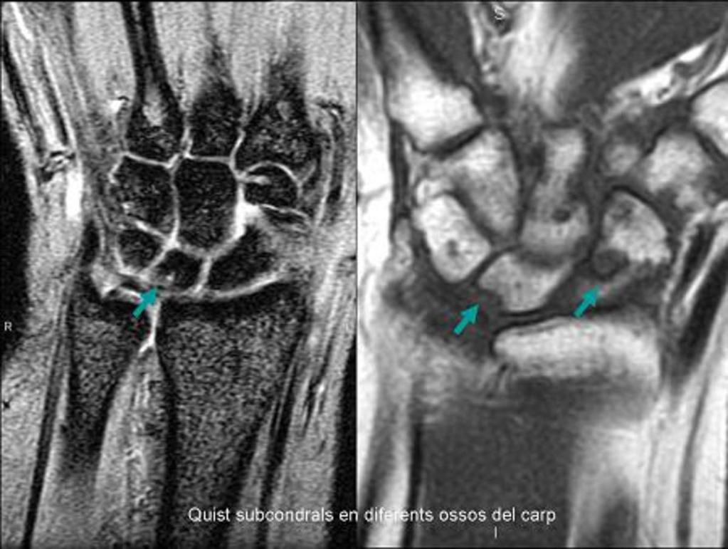 Fig. 8: Estudio coronal de muñeca en T2 GRE y T1 donde se observa la presencia de lesiones