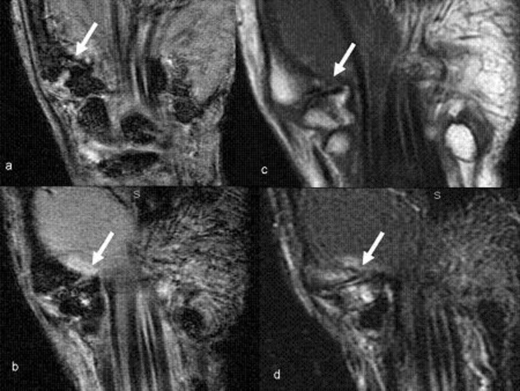 Fig. 33: Rizartrosis (artrosis