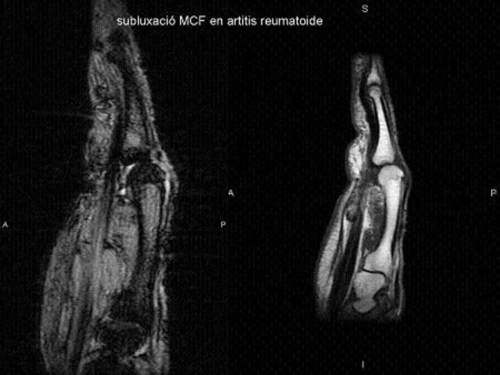 Fig. 37: Subluxación MCF en artritis