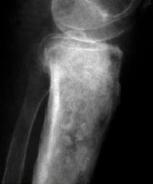 Complicaciones: - Fracturas patológicas - Malignización a condrosarcoma (2% a 3% de los casos). Casi exclusivo de los encondromas de huesos largos.