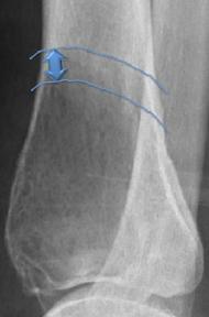 Lesiones de crecimiento lento / benignas Lesiones malignas / agresivas 6- Patrón de destrucción ósea Indica la velocidad de