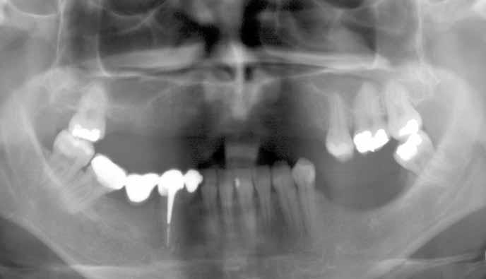 Reconstrucción de maxilar atrófico con injertos córtico-esponjosos de cresta iliaca e injertos conectivos Dr.