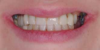 edentulismo. Sin la prótesis removible de resina, la paciente pierde todo el soporte del labio superior.