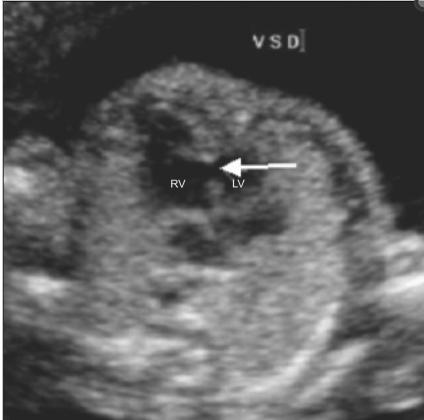 Diagnóstico prenatal Corte de 4 cámaras: CIV musculares Lai W et al.