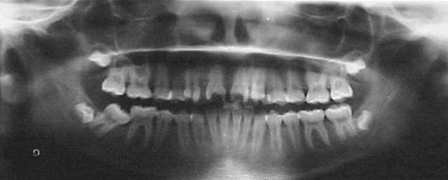Expansión maxilar, en la corrección de mordida cruzada posterior derecha.. 39 Fig. 4. Radiografía Panorámica. Fig. 5. Comparación Oclusal Superior Inicio-Progreso.