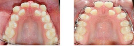 mientras los dientes se desplazan de forma mínima, por día la separación lograda es de 0,2 a 0,5 mm y resulta un incremento intermolar hasta de 8 mm. Efectos sobre el complejo maxilar.