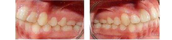 En el análisis intraoral de inicio: en las fotografías intraorales nos muestran: la clase II molar derecha, clase I molar izquierda, clase II canina bilateral figura, la mordida cruzada en los